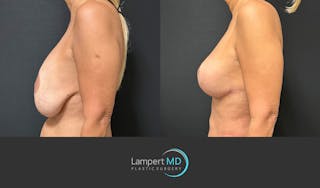 Breast Fat Transfer Before & After Gallery - Patient 194947 - Image 4