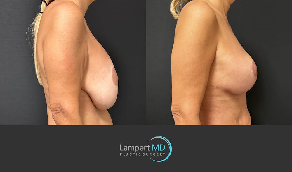 Breast Fat Transfer Before & After Gallery - Patient 194947 - Image 5