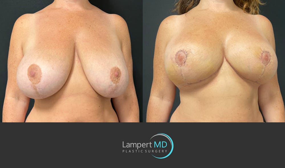 Breast Explant Before & After Gallery - Patient 138369 - Image 2