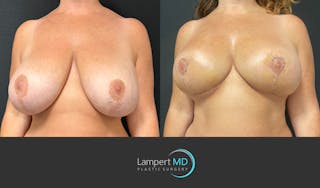 Breast Explant Before & After Gallery - Patient 138369 - Image 3