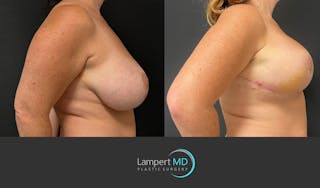 Breast Explant Before & After Gallery - Patient 138369 - Image 4