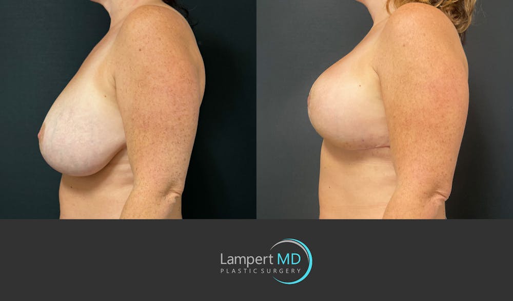 Breast Explant Before & After Gallery - Patient 138369 - Image 5