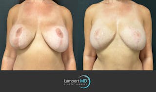 Breast Fat Transfer Before & After Gallery - Patient 256482 - Image 1