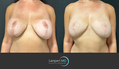 Breast Fat Transfer Before & After Gallery - Patient 256482 - Image 1