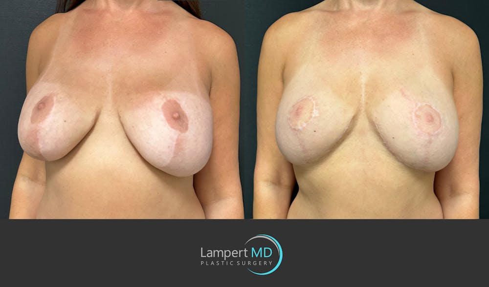 Breast Fat Transfer Before & After Gallery - Patient 256482 - Image 2