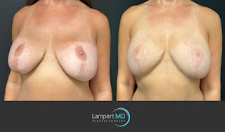 Breast Fat Transfer Before & After Gallery - Patient 256482 - Image 2