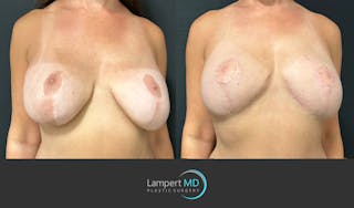 Breast Fat Transfer Before & After Gallery - Patient 256482 - Image 3