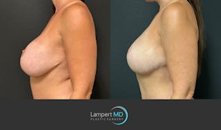 Breast Fat Transfer Before & After Gallery - Patient 256482 - Image 4