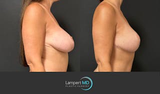 Breast Fat Transfer Before & After Gallery - Patient 256482 - Image 5