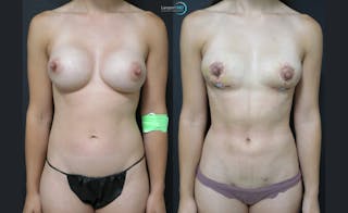 Breast Fat Transfer Before & After Gallery - Patient 262840 - Image 1