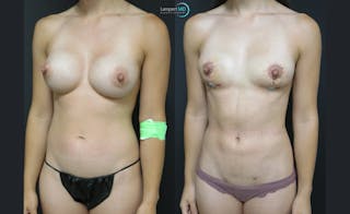 Breast Fat Transfer Before & After Gallery - Patient 262840 - Image 3