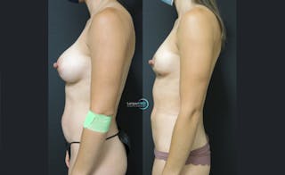 Breast Fat Transfer Before & After Gallery - Patient 262840 - Image 5