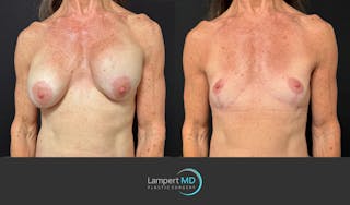 Breast Explant Before & After Gallery - Patient 248199 - Image 2