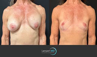 Breast Explant Before & After Gallery - Patient 248199 - Image 1