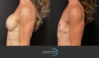 Breast Explant Before & After Gallery - Patient 248199 - Image 5