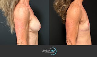 Breast Explant Before & After Gallery - Patient 248199 - Image 4