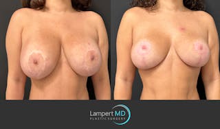 Breast Explant Before & After Gallery - Patient 220083 - Image 2