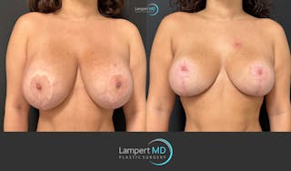 Breast Explant Before & After Gallery - Patient 220083 - Image 1