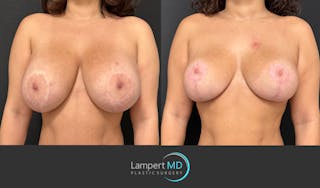 Breast Explant Before & After Gallery - Patient 220083 - Image 3