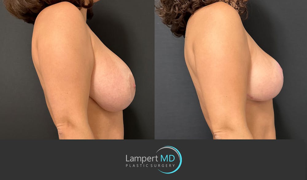 Breast Explant Before & After Gallery - Patient 220083 - Image 4
