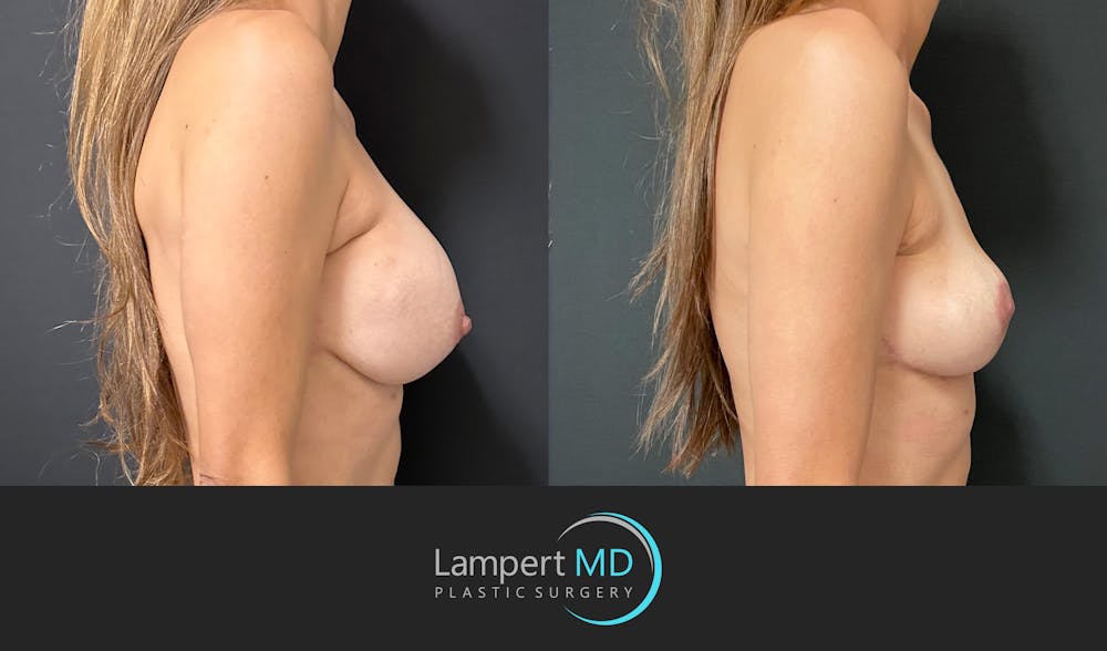 Breast Explant Before & After Gallery - Patient 356229 - Image 3
