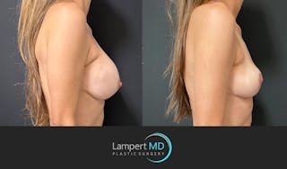 Breast Explant Before & After Gallery - Patient 356229 - Image 3