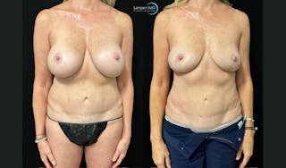 Breast Fat Transfer Before & After Gallery - Patient 279351 - Image 2