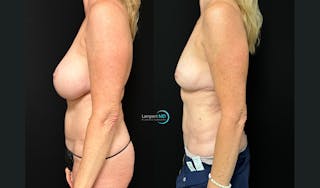 Breast Fat Transfer Before & After Gallery - Patient 279351 - Image 3