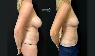 Breast Fat Transfer Before & After Gallery - Patient 279351 - Image 4