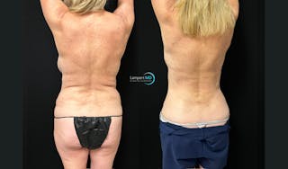Breast Fat Transfer Before & After Gallery - Patient 279351 - Image 5