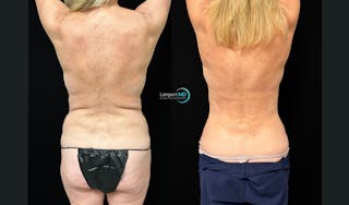 Breast Fat Transfer Before & After Gallery - Patient 279351 - Image 6
