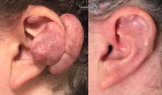 Ear Lobe Repair and Ear Reconstruction Before & After Gallery - Patient 260758 - Image 1