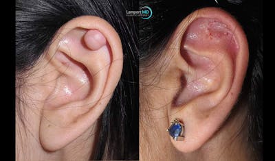 Ear Lobe Repair and Ear Reconstruction Before & After Gallery - Patient 261798 - Image 1