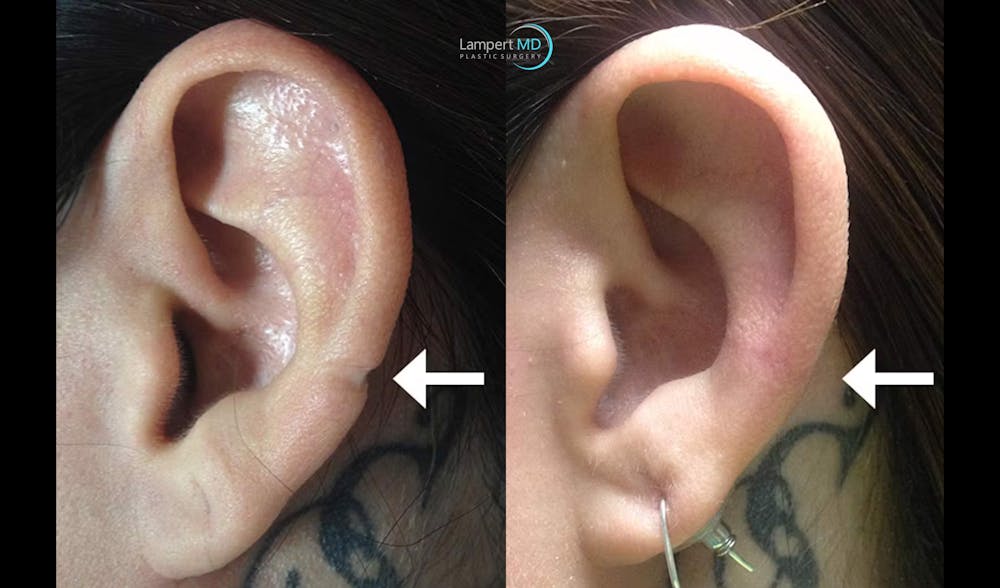 Ear Lobe Repair and Ear Reconstruction Before & After Gallery - Patient 179045 - Image 1
