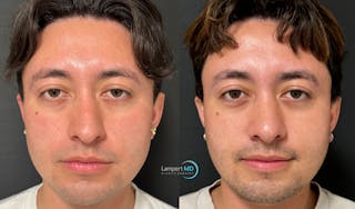 Rhinoplasty Before & After Gallery - Patient 346516 - Image 1