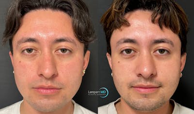 Rhinoplasty Before & After Gallery - Patient 346516 - Image 1