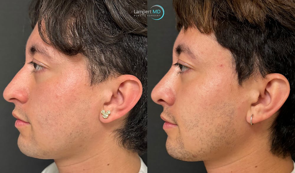 Rhinoplasty Before & After Gallery - Patient 346516 - Image 5