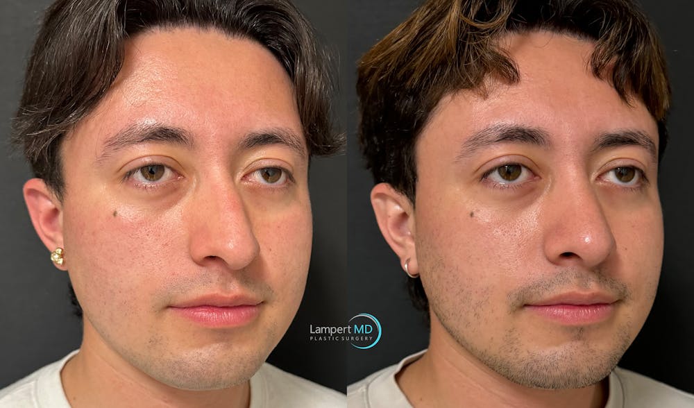 Rhinoplasty Before & After Gallery - Patient 346516 - Image 2