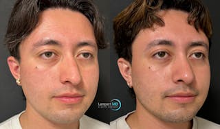 Rhinoplasty Before & After Gallery - Patient 346516 - Image 2
