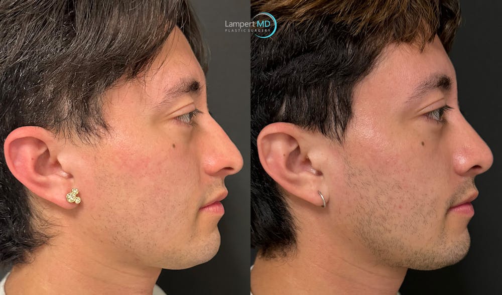 Rhinoplasty Before & After Gallery - Patient 346516 - Image 3