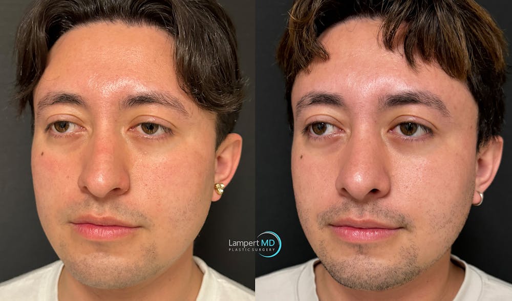 Rhinoplasty Before & After Gallery - Patient 346516 - Image 4