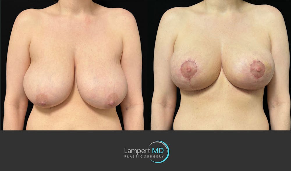 Breast Lift Before & After Gallery - Patient 179758 - Image 1