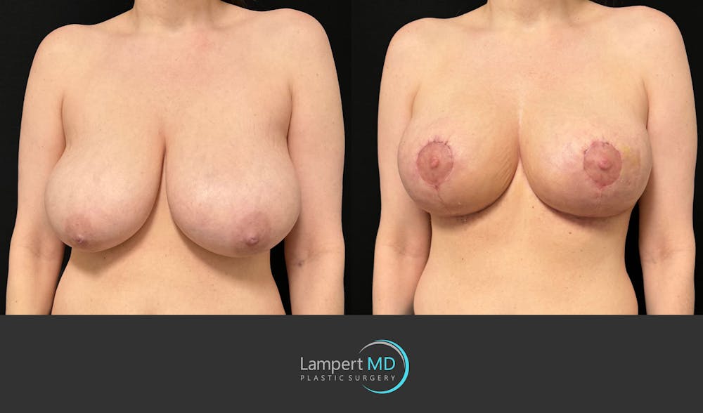 Breast Lift Before & After Gallery - Patient 179758 - Image 3
