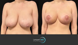 Breast Lift Before & After Gallery - Patient 179758 - Image 3