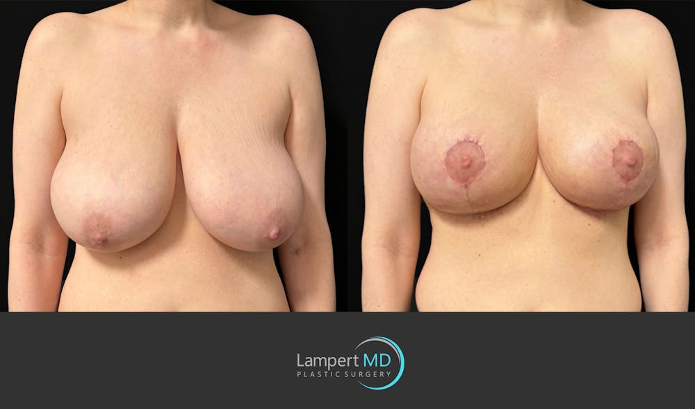 Breast Lift Before & After Gallery - Patient 179758 - Image 2