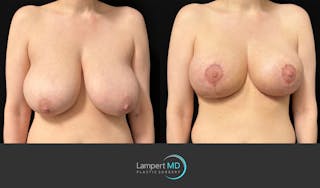 Breast Lift Before & After Gallery - Patient 179758 - Image 2