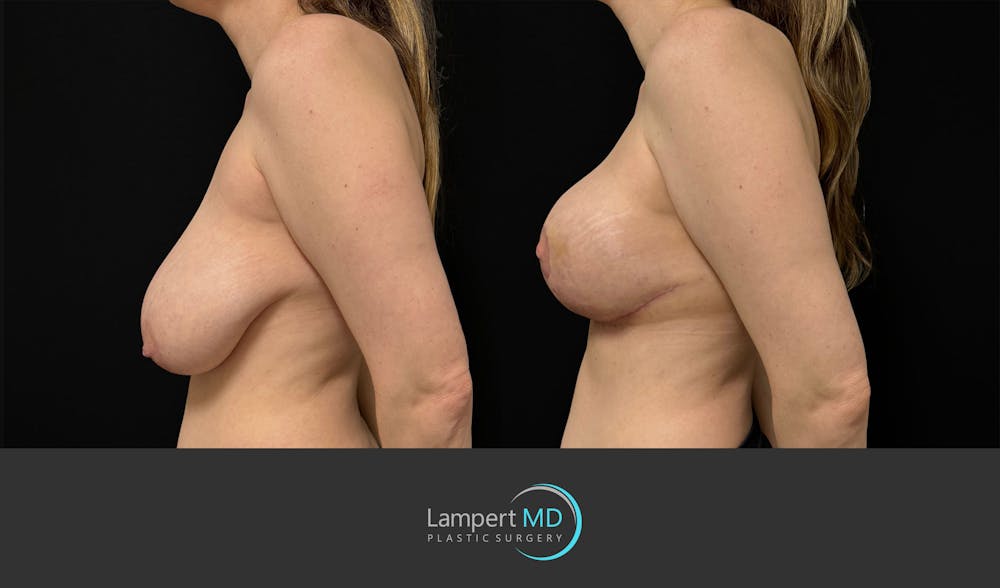 Breast Lift Before & After Gallery - Patient 179758 - Image 5