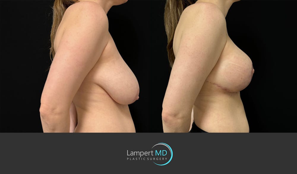 Breast Lift Before & After Gallery - Patient 179758 - Image 4