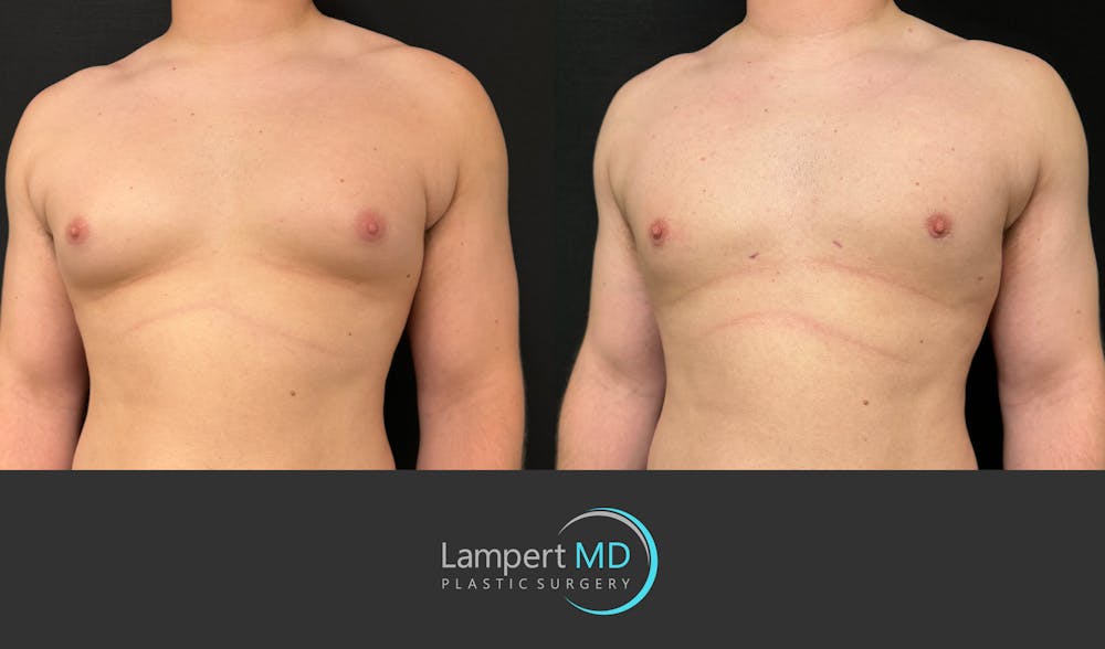 Gynecomastia Before & After Gallery - Patient 144405065 - Image 2