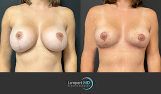 Breast Fat Transfer Before & After Gallery - Patient 285620 - Image 1